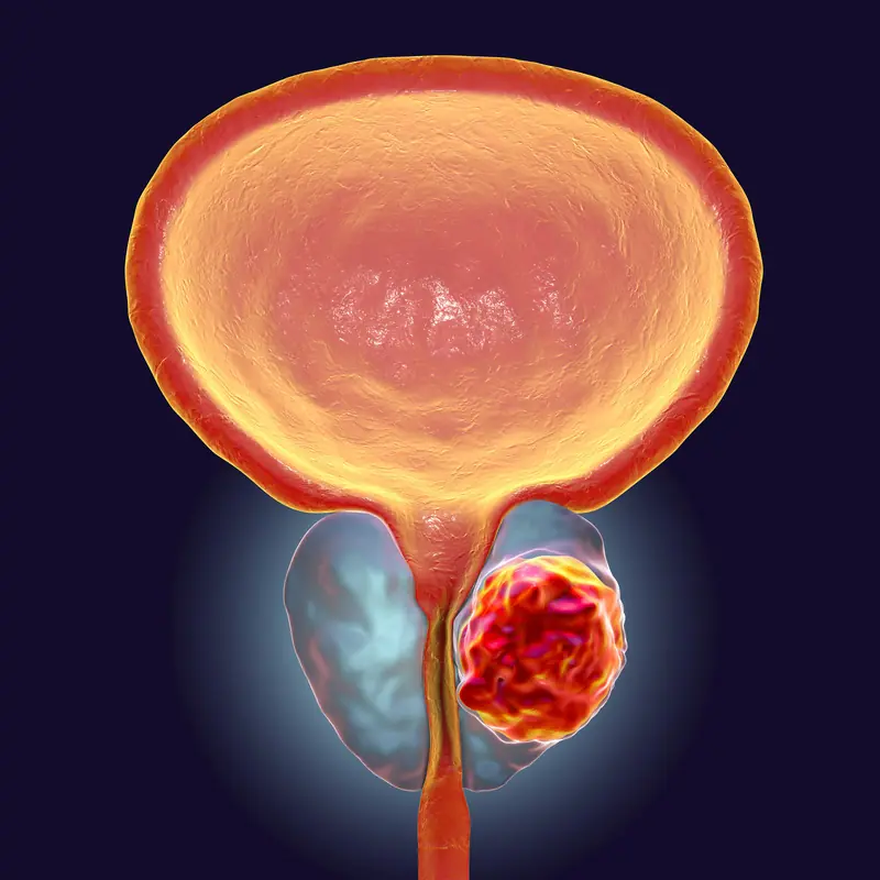 Cancer de la prostate