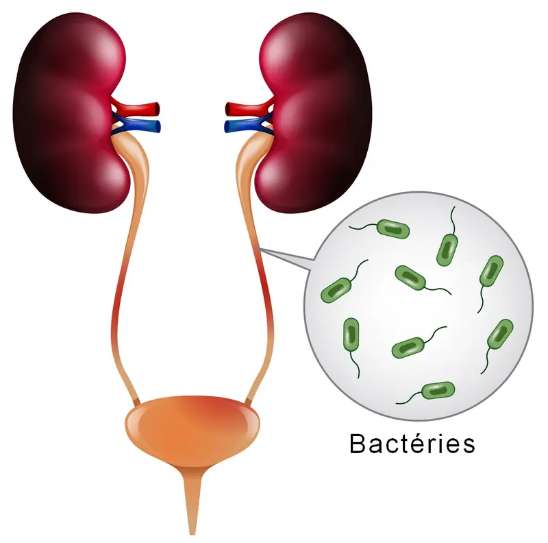 Infections uro génitales