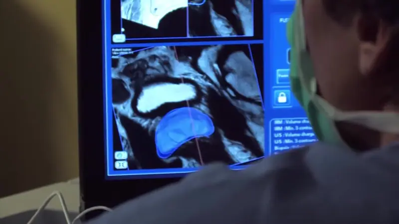 Un chirurgien délimite la prostate sur les images de l’IRM