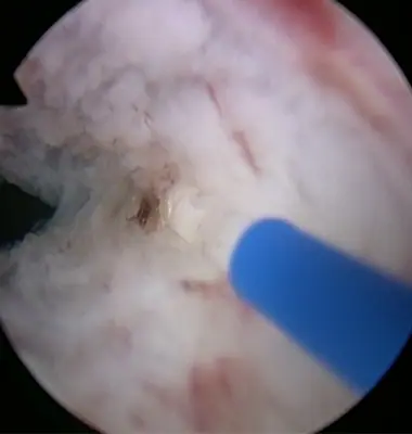 Nouveau Laser Holmium Calculs et Prostate ( HOLEP)