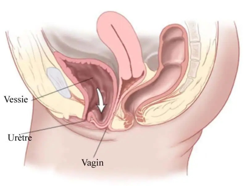 Prolapsus