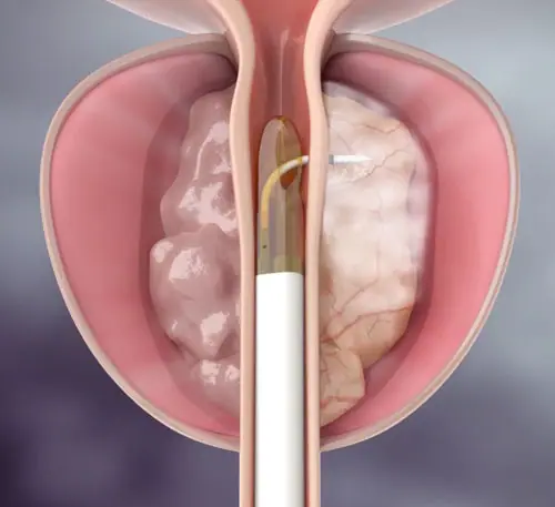 Révolution dans le Traitement de l'Hypertrophie Bénigne de la Prostate : Bienvenue au REZUM à la Clinique Saint Jean Sud de France