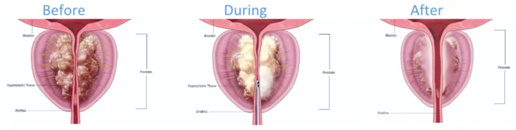 Révolution dans le Traitement de l'Hypertrophie Bénigne de la Prostate — photo 1