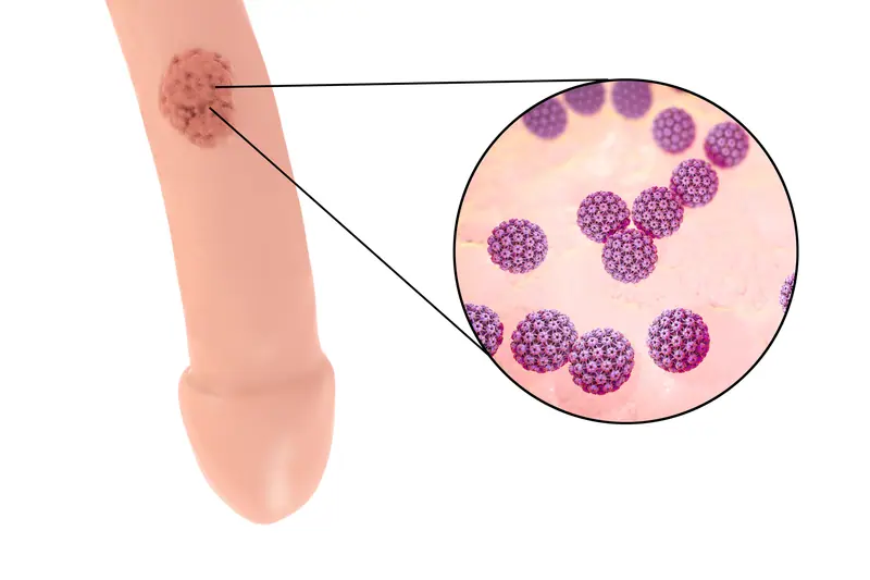 Cancer du pénis