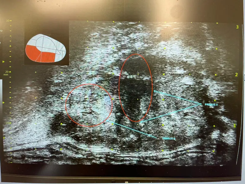 Échographie de la prostate pendant la biopsie, avec les zones ciblées