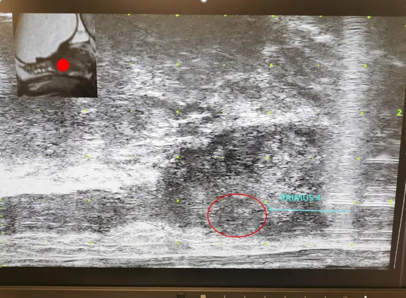 Échographie de la prostate avec la cible repérée à l’IRM