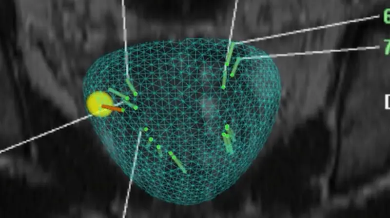 Modèle 3D de la prostate issu de la fusion IRM-échographie, avec les trajectoires des biopsies